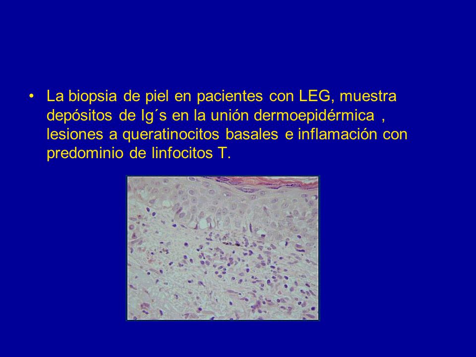 La biopsia de piel en pacientes con LEG, muestra depósitos de Ig´s en la unión dermoepidérmica , lesiones a queratinocitos basales e inflamación con predominio de linfocitos T.