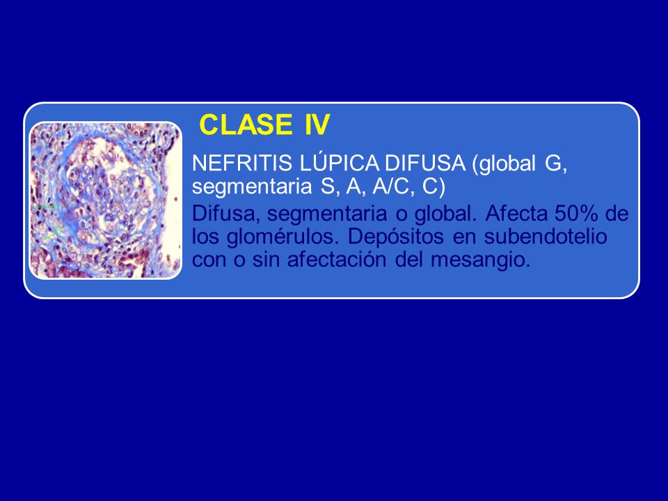 CLASE IV NEFRITIS LÚPICA DIFUSA (global G, segmentaria S, A, A/C, C)