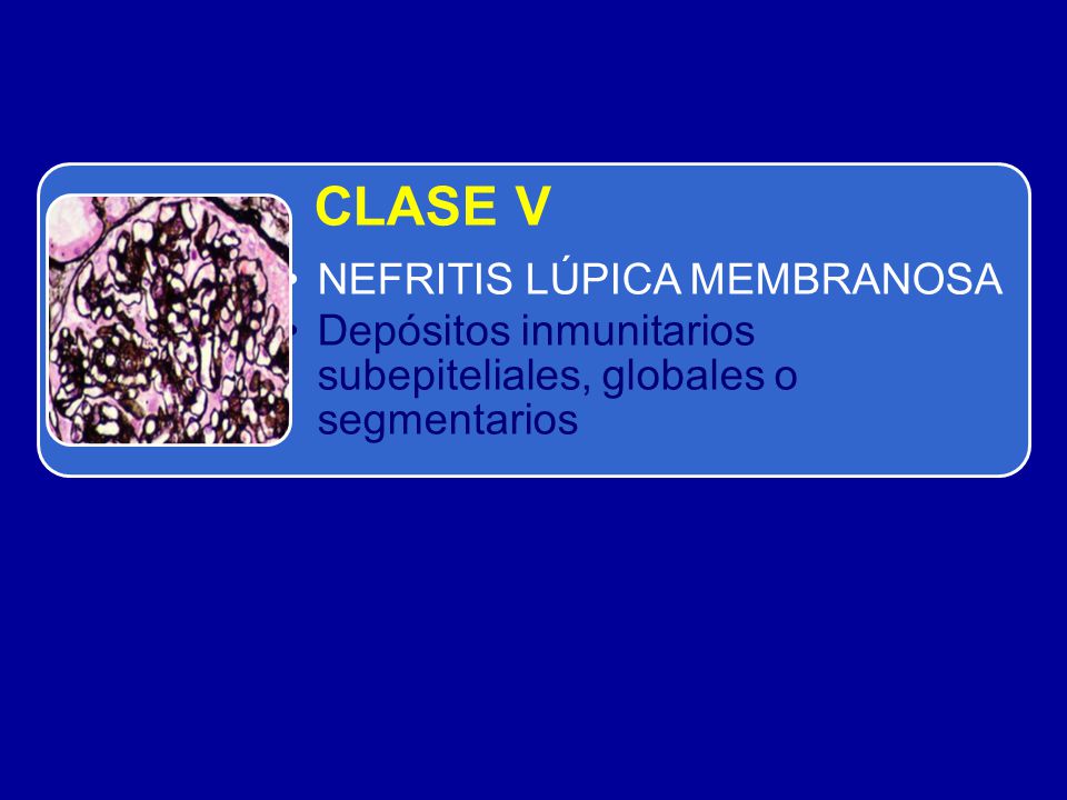 CLASE V NEFRITIS LÚPICA MEMBRANOSA Depósitos inmunitarios subepiteliales, globales o segmentarios