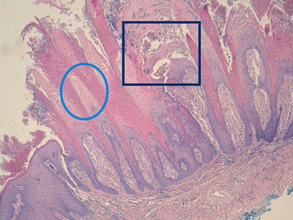 A bajo aumento ya podemos apreciar todas las características tipicas de esta lesion, observamos una lesion de morfologia papilomatosa con marcada hiperparaqueratosis,adquiriendo la capa cornea una coloracion orangofila, entremezclada con acumulos bacterianos y presencia asi mismo de leucocitos polinucleares neutrofilos.