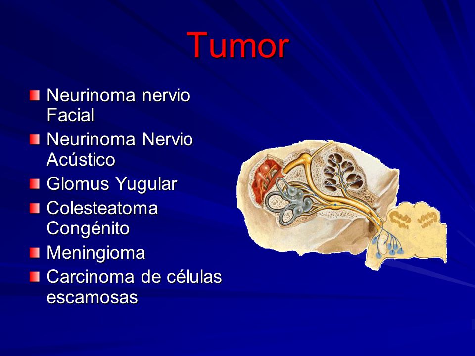 Tumor Neurinoma nervio Facial Neurinoma Nervio Acústico Glomus Yugular