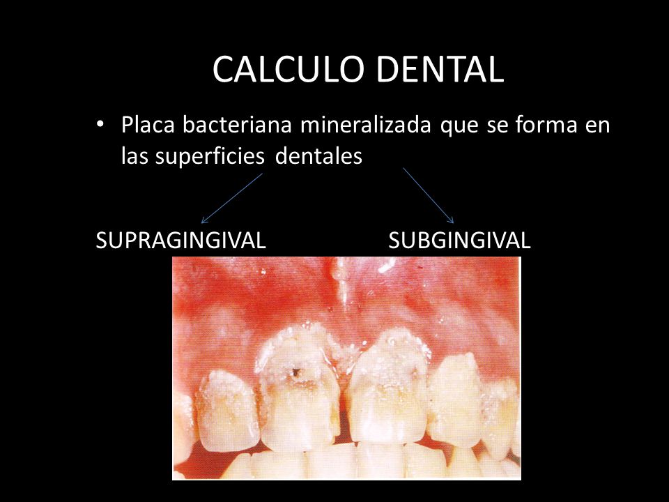 CALCULO DENTAL Placa bacteriana mineralizada que se forma en las superficies dentales.