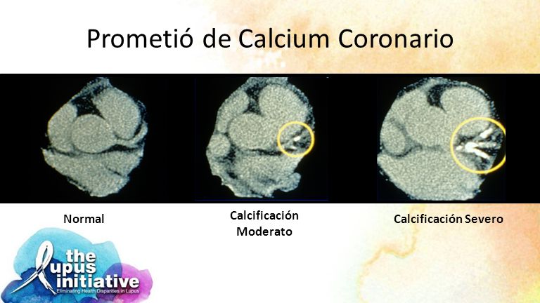 Prometió de Calcium Coronario