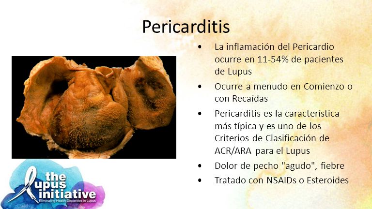 Pericarditis La inflamación del Pericardio ocurre en 11-54% de pacientes de Lupus. Ocurre a menudo en Comienzo o con Recaídas.