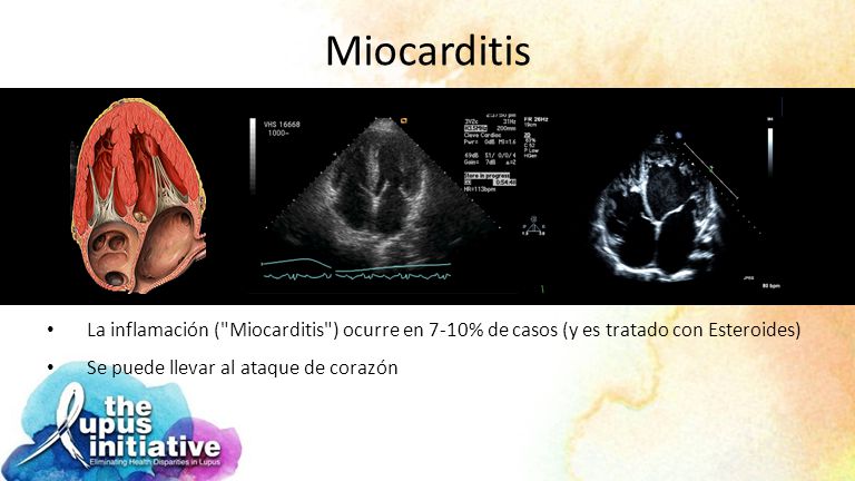 Miocarditis La inflamación ( Miocarditis ) ocurre en 7-10% de casos (y es tratado con Esteroides) Se puede llevar al ataque de corazón.