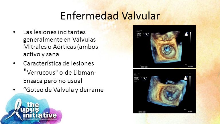 Enfermedad Valvular Las lesiones incitantes generalmente en Válvulas Mitrales o Aórticas (ambos activo y sana.