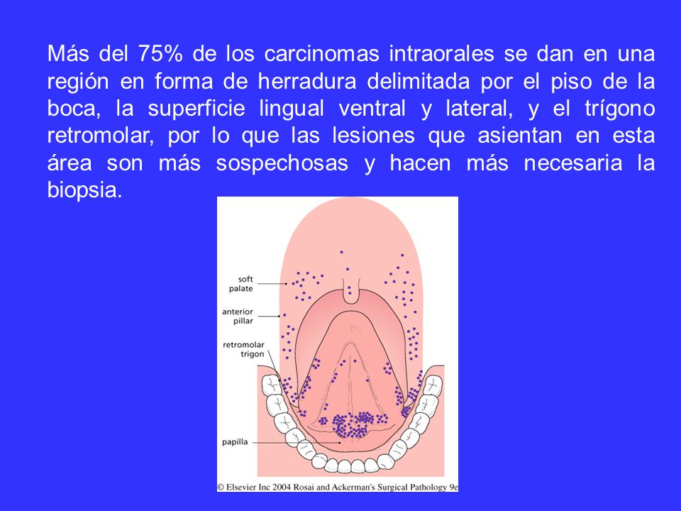 Más del 75% de los carcinomas intraorales se dan en una región en forma de herradura delimitada por el piso de la boca, la superficie lingual ventral y lateral, y el trígono retromolar, por lo que las lesiones que asientan en esta área son más sospechosas y hacen más necesaria la biopsia.