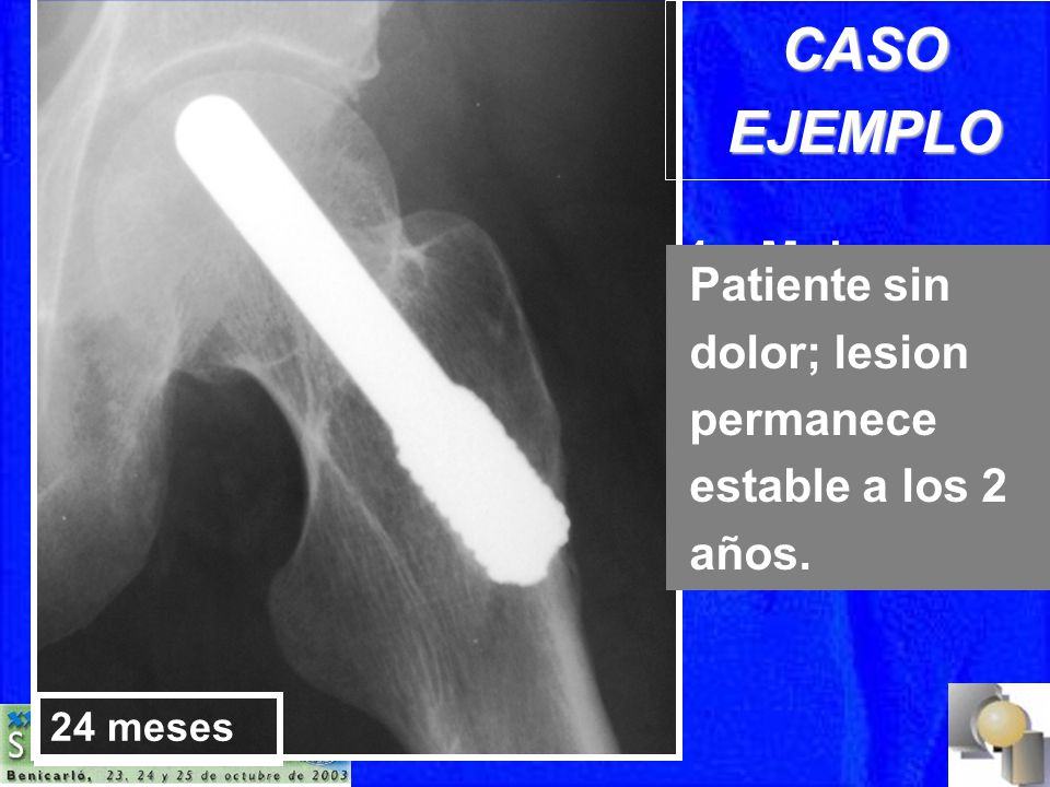 24 meses CASO EJEMPLO. 74 a Mujer. Stadio IIa ON. Fracaso Renal, post transplante renal.