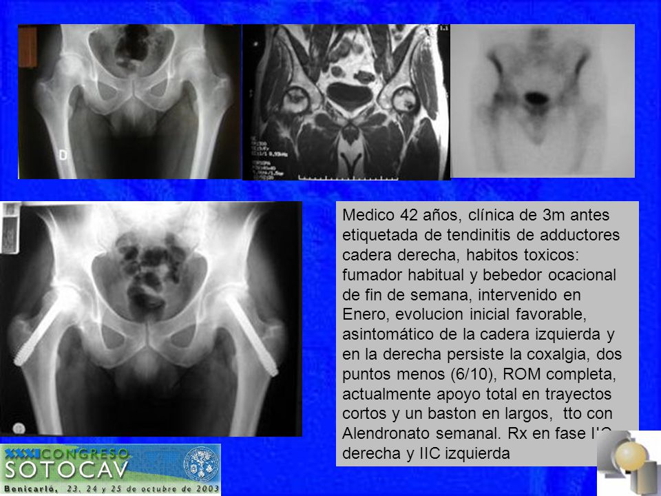 Medico 42 años, clínica de 3m antes etiquetada de tendinitis de adductores cadera derecha, habitos toxicos: fumador habitual y bebedor ocacional de fin de semana, intervenido en Enero, evolucion inicial favorable, asintomático de la cadera izquierda y en la derecha persiste la coxalgia, dos puntos menos (6/10), ROM completa, actualmente apoyo total en trayectos cortos y un baston en largos, tto con Alendronato semanal.