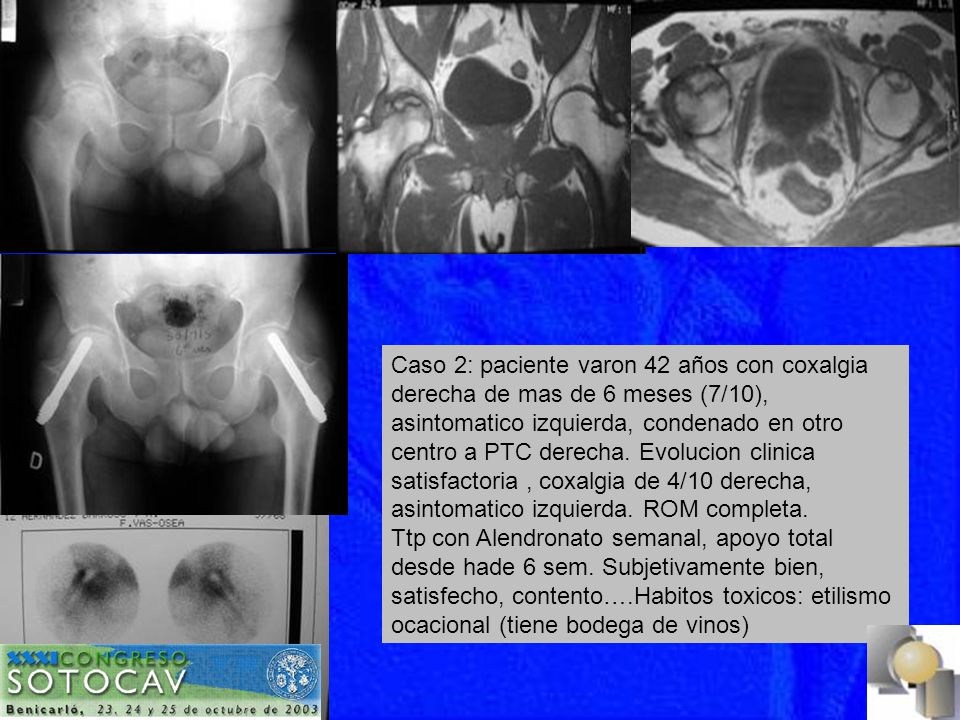 Caso 2: paciente varon 42 años con coxalgia derecha de mas de 6 meses (7/10), asintomatico izquierda, condenado en otro centro a PTC derecha. Evolucion clinica satisfactoria , coxalgia de 4/10 derecha, asintomatico izquierda. ROM completa.