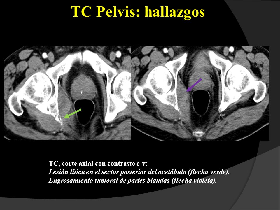 TC Pelvis: hallazgos TC, corte axial con contraste e-v: