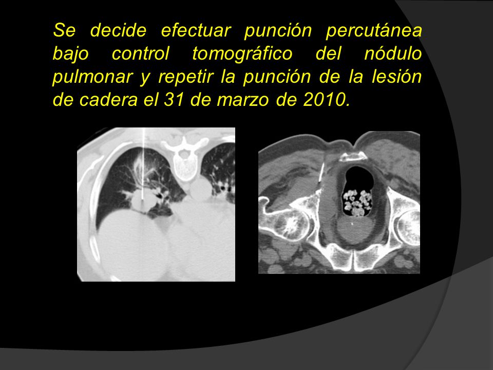 Se decide efectuar punción percutánea bajo control tomográfico del nódulo pulmonar y repetir la punción de la lesión de cadera el 31 de marzo de 2010.