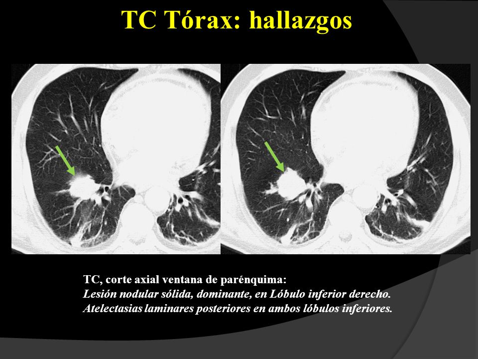 TC Tórax: hallazgos TC, corte axial ventana de parénquima: