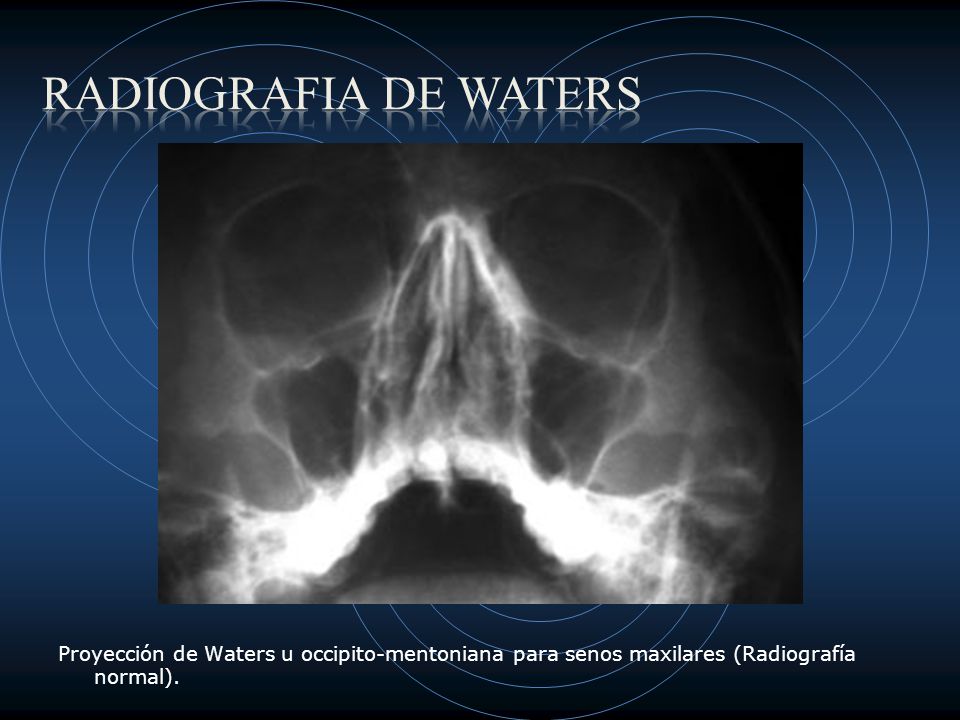 Radiografia de Waters Proyección de Waters u occipito-mentoniana para senos maxilares (Radiografía normal).