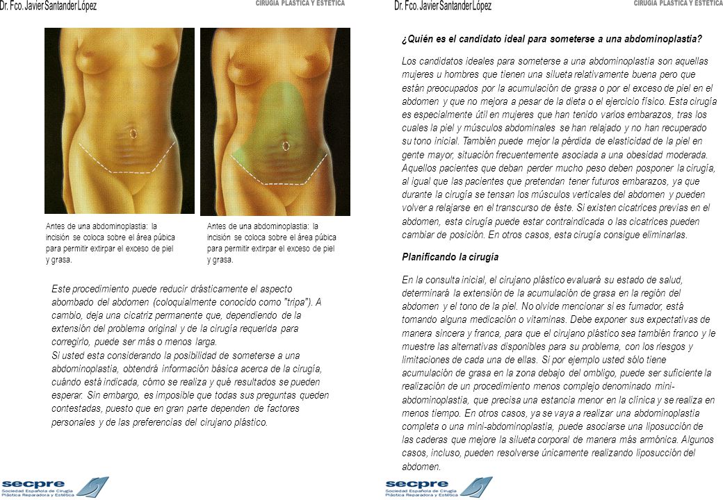 ¿Quién es el candidato ideal para someterse a una abdominoplastia