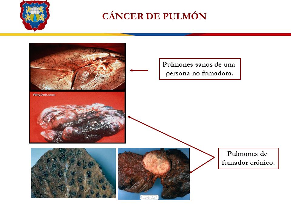 CÁNCER DE PULMÓN Pulmones sanos de una persona no fumadora.