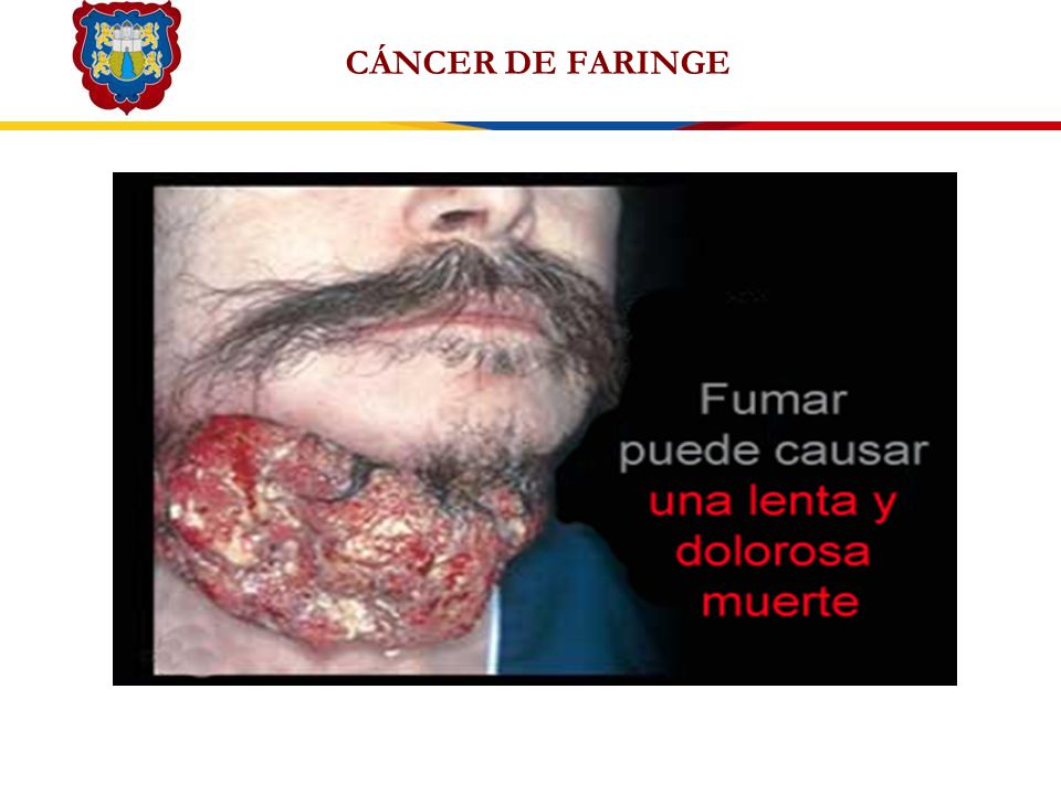 CÁNCER DE FARINGE