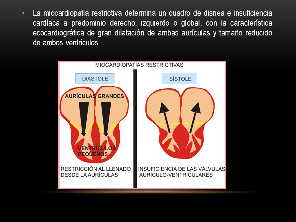La miocardiopatia restrictiva determina un cuadro de disnea e insuficiencia cardíaca a predominio derecho, izquierdo o global, con la característica ecocardiográfica de gran dilatación de ambas aurículas y tamaño reducido de ambos ventrículos