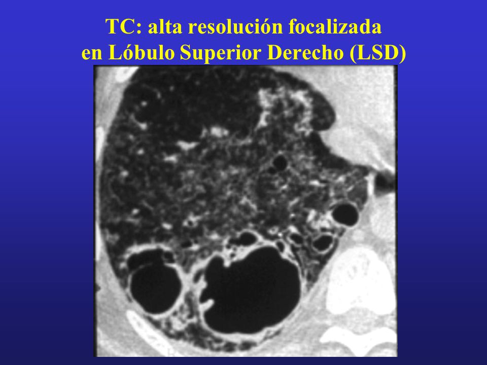 TC: alta resolución focalizada en Lóbulo Superior Derecho (LSD)