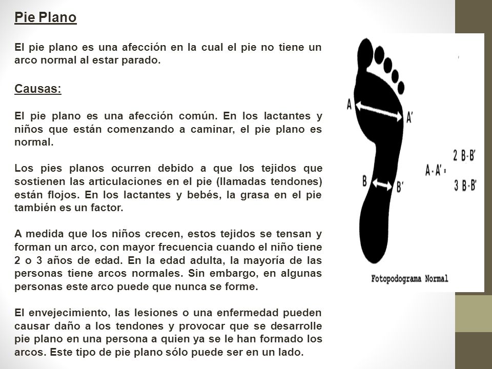 Pie Plano El pie plano es una afección en la cual el pie no tiene un arco normal al estar parado. Causas: