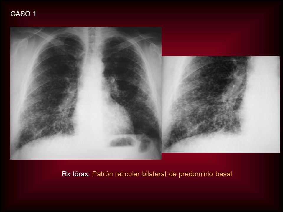 CASO 1 Rx tórax: Patrón reticular bilateral de predominio basal