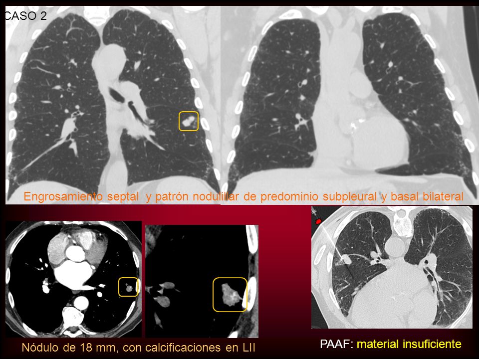 CASO 2 Engrosamiento septal y patrón nodulillar de predominio subpleural y basal bilateral. PAAF: material insuficiente.