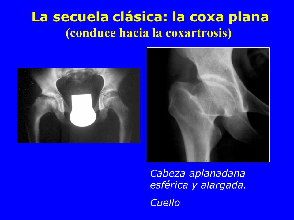 La secuela clásica: la coxa plana (conduce hacia la coxartrosis)