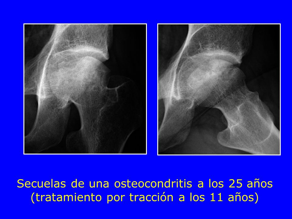 Secuelas de una osteocondritis a los 25 años (tratamiento por tracción a los 11 años)