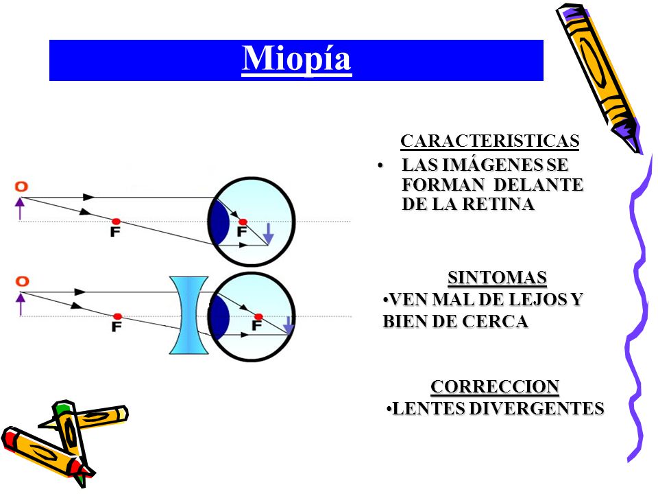 Miopía CARACTERISTICAS LAS IMÁGENES SE FORMAN DELANTE DE LA RETINA