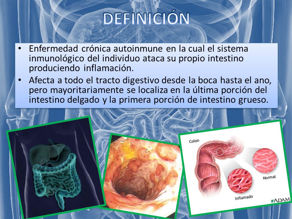 DEFINICIÓN Enfermedad crónica autoinmune en la cual el sistema inmunológico del individuo ataca su propio intestino produciendo inflamación.