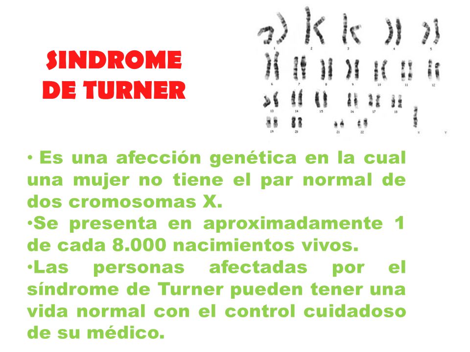 SINDROME DE TURNER. Es una afección genética en la cual una mujer no tiene el par normal de dos cromosomas X.