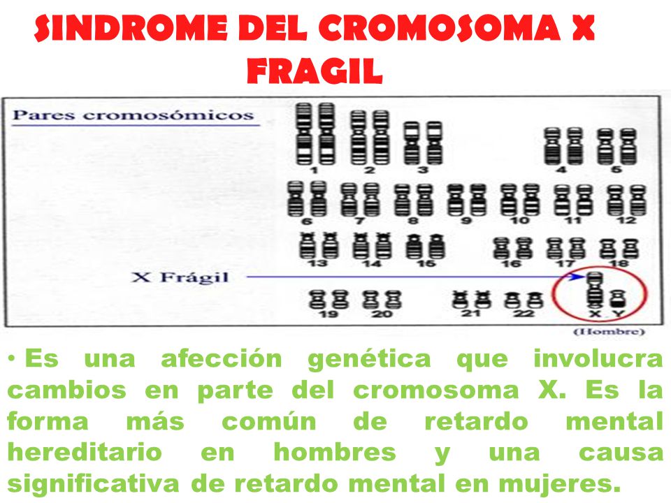 SINDROME DEL CROMOSOMA X FRAGIL