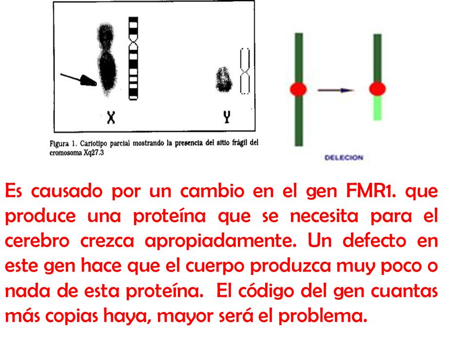 Es causado por un cambio en el gen FMR1