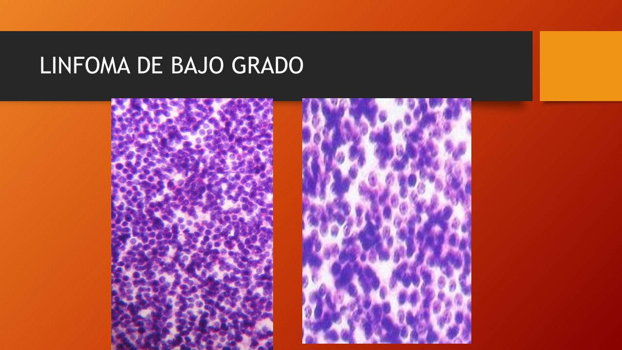 LINFOMA DE BAJO GRADO