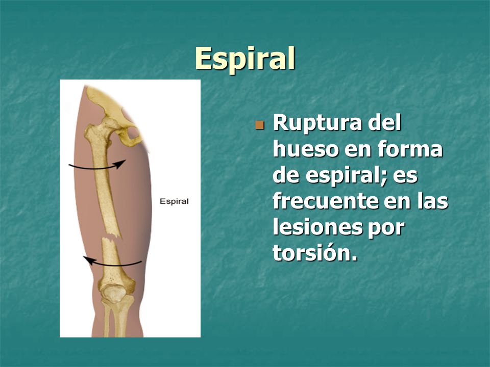 Espiral Ruptura del hueso en forma de espiral; es frecuente en las lesiones por torsión.