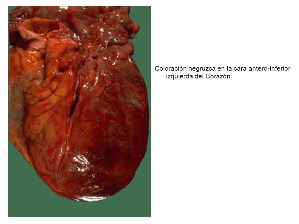 Coloración negruzca en la cara antero-inferior izquierda del Corazón