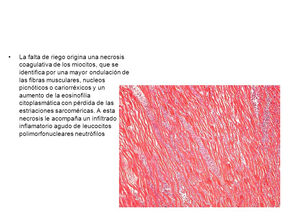 La falta de riego origina una necrosis coagulativa de los miocitos, que se identifica por una mayor ondulación de las fibras musculares, nucleos picnóticos o cariorréxicos y un aumento de la eosinofilia citoplasmática con pérdida de las estriaciones sarcoméricas.