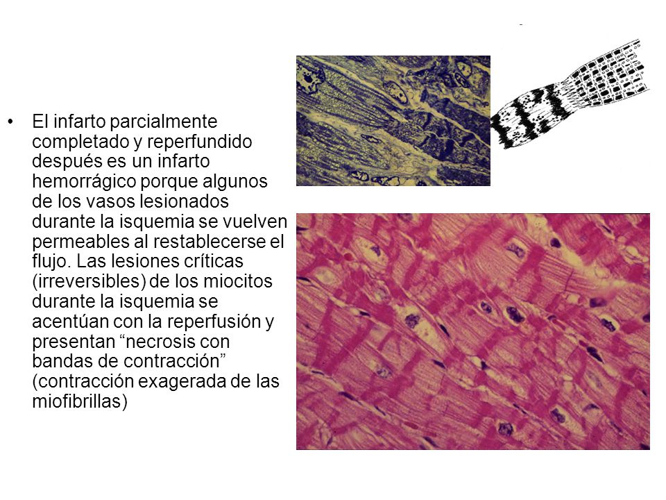 El infarto parcialmente completado y reperfundido después es un infarto hemorrágico porque algunos de los vasos lesionados durante la isquemia se vuelven permeables al restablecerse el flujo. Las lesiones críticas (irreversibles) de los miocitos durante la isquemia se acentúan con la reperfusión y presentan necrosis con bandas de contracción (contracción exagerada de las miofibrillas)