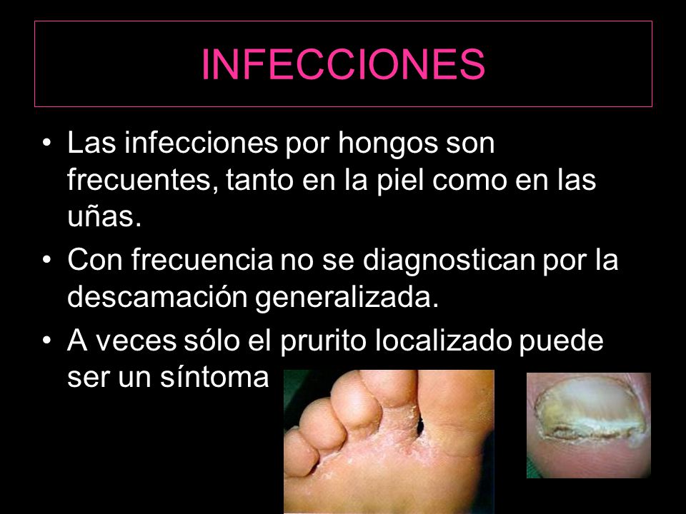 INFECCIONES Las infecciones por hongos son frecuentes, tanto en la piel como en las uñas.