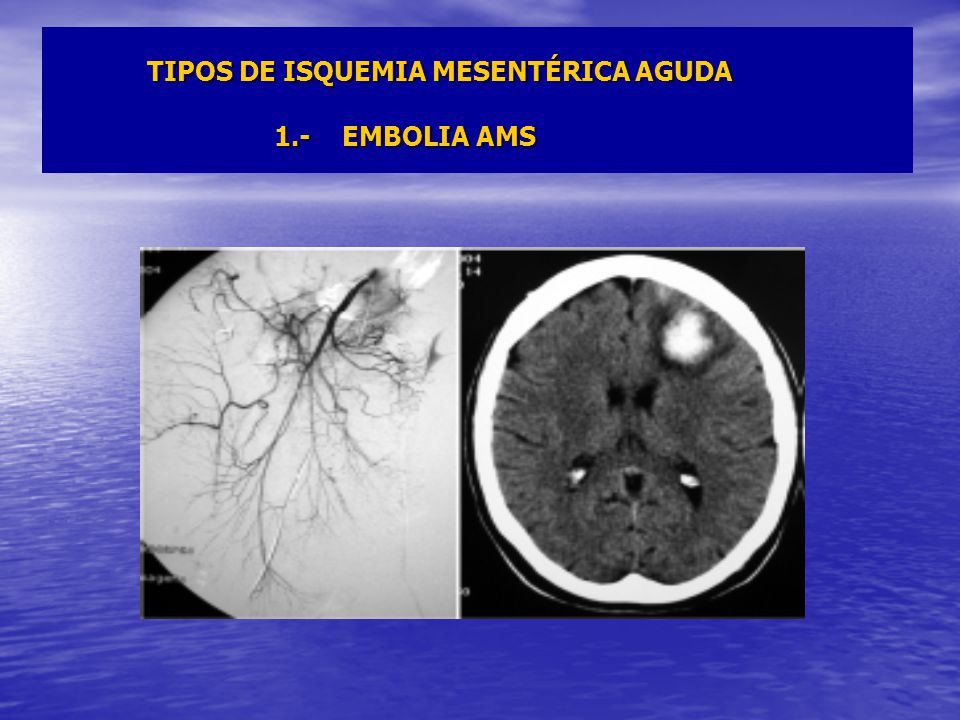 TIPOS DE ISQUEMIA MESENTÉRICA AGUDA 1.- EMBOLIA AMS