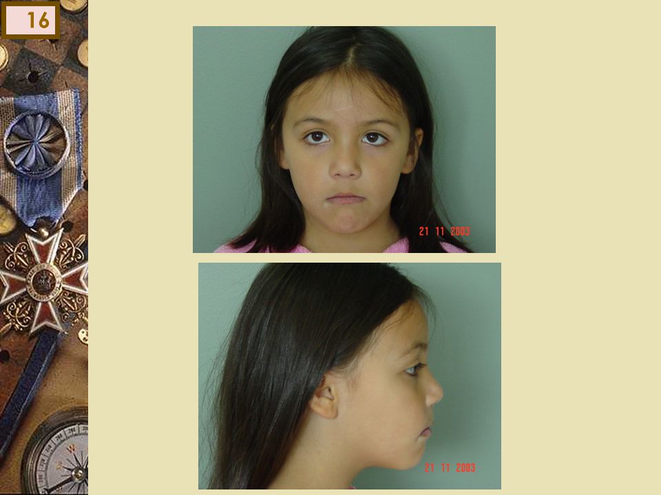 Examen facial Sexo femenino 7 años F.G.C Derivada de la Dra. Simunovic