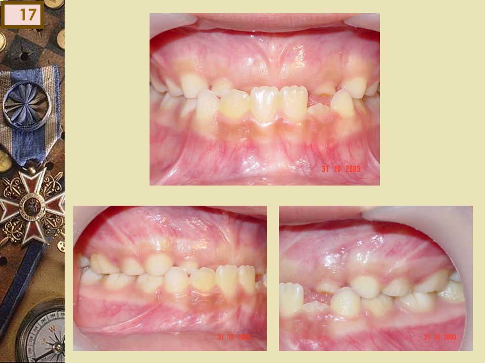 . Clase I Examen intraoral :mordida invertida en neutro molar