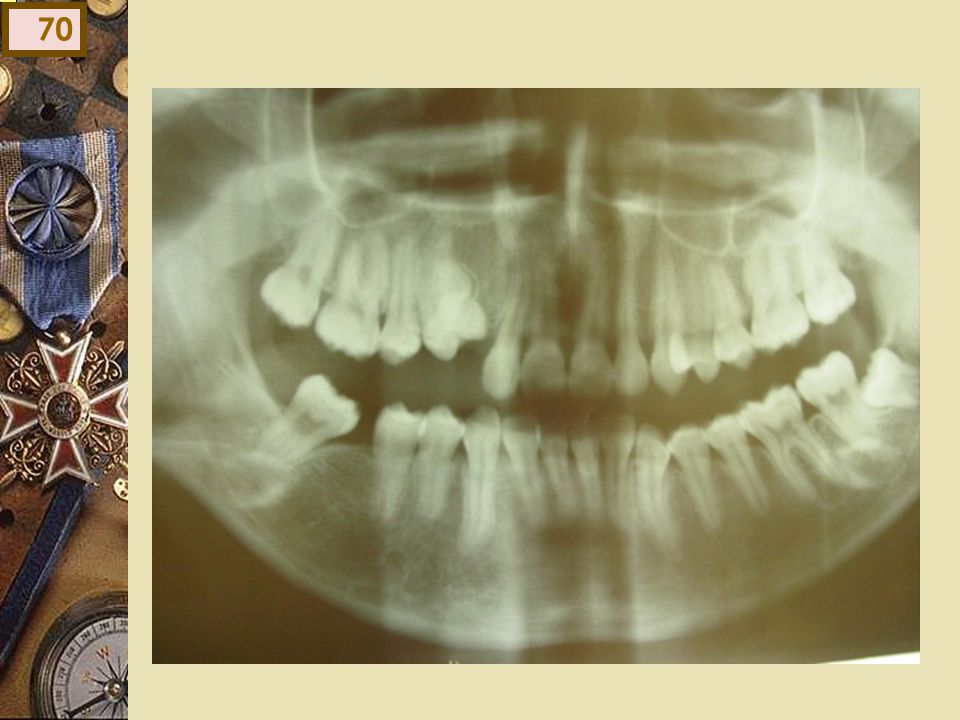 Rx: odontoma en zona pieza 6 y ausencia de canino