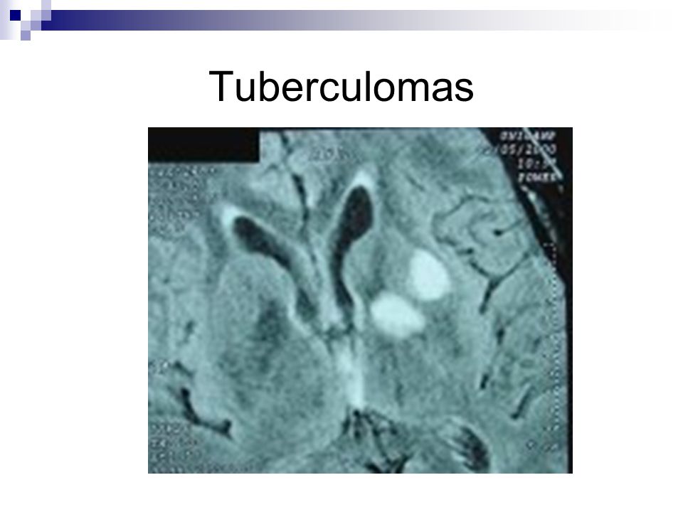 Tuberculomas