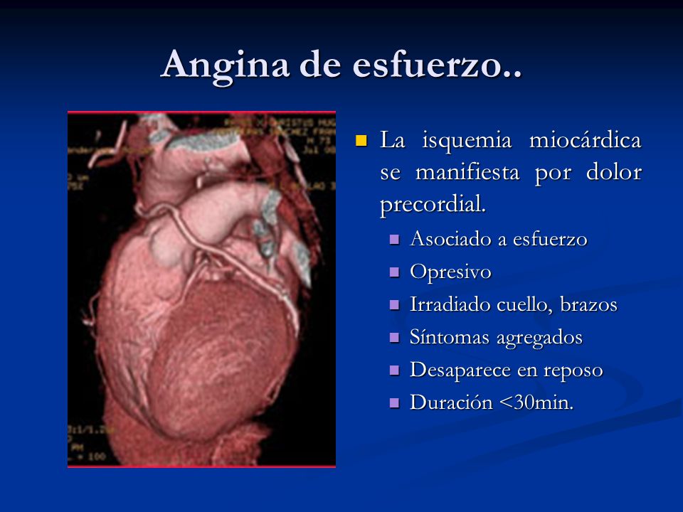 Angina de esfuerzo.. La isquemia miocárdica se manifiesta por dolor precordial. Asociado a esfuerzo.