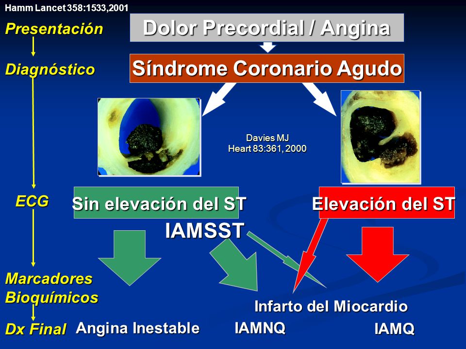 Síndrome Coronario Agudo Dolor Precordial / Angina