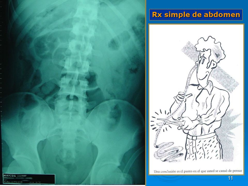 Rx simple de abdomen