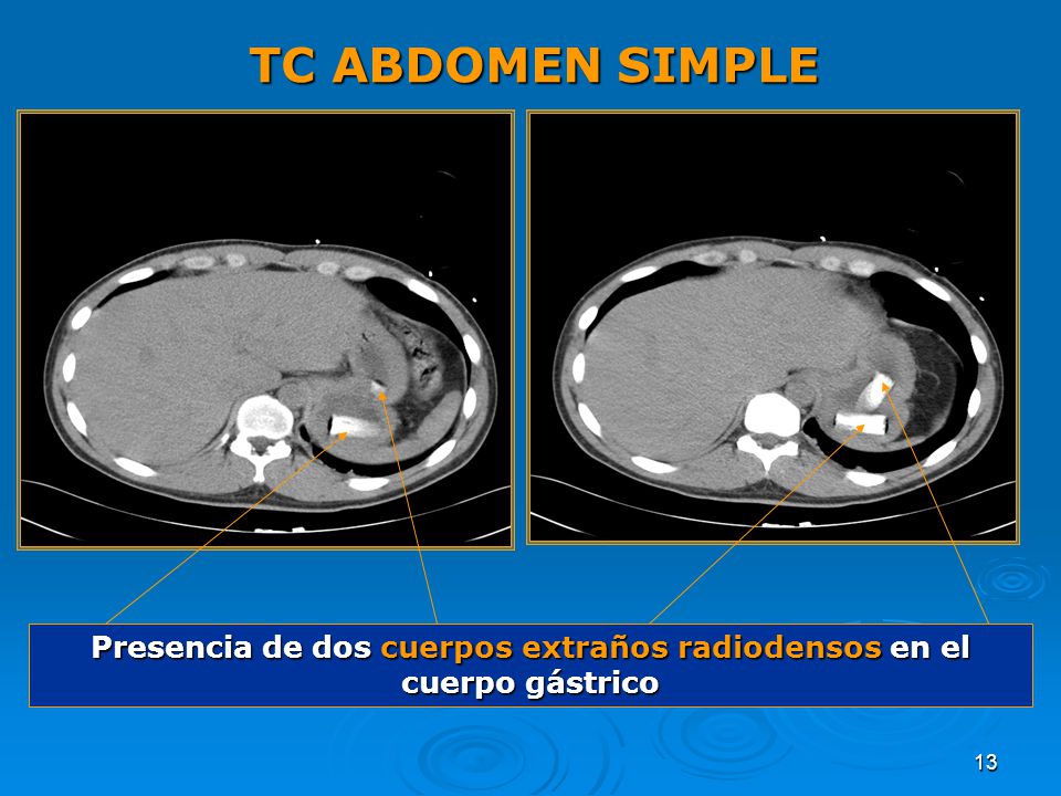 Presencia de dos cuerpos extraños radiodensos en el cuerpo gástrico
