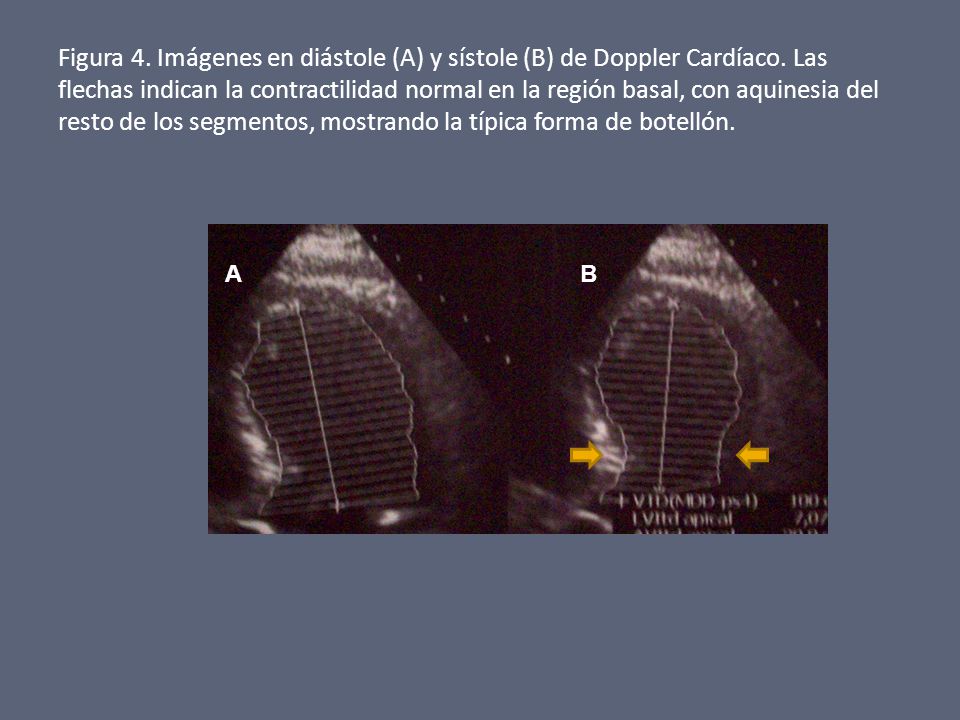 Figura 4. Imágenes en diástole (A) y sístole (B) de Doppler Cardíaco