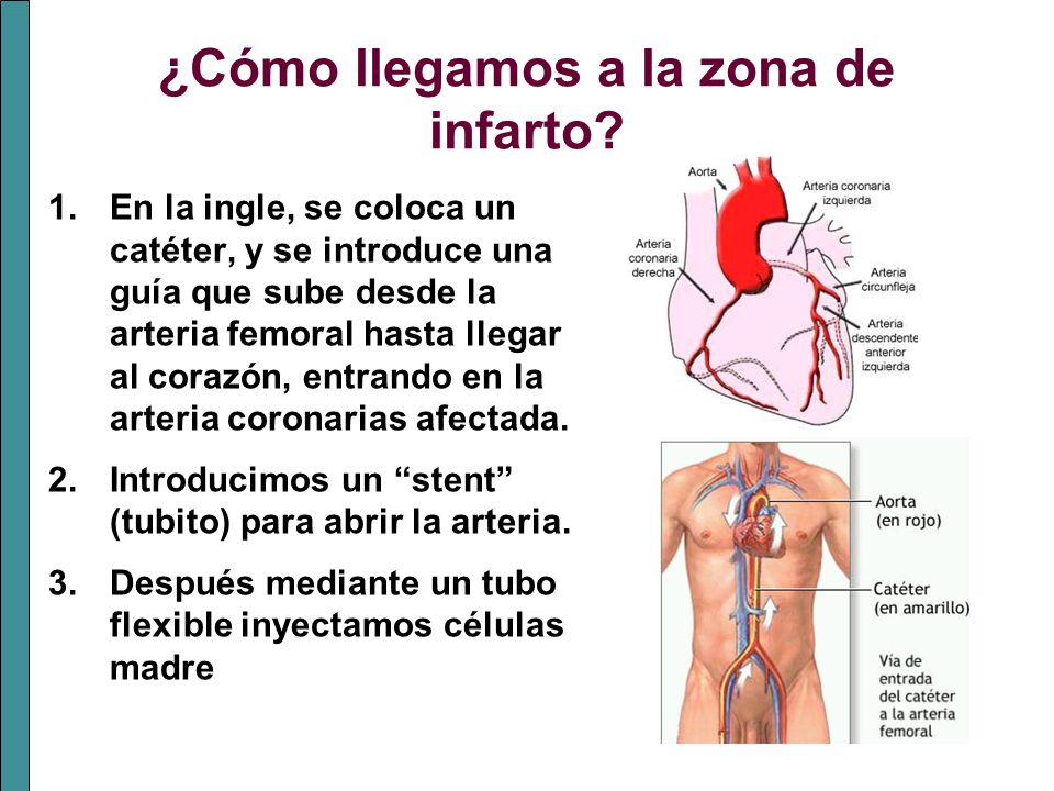 ¿Cómo llegamos a la zona de infarto